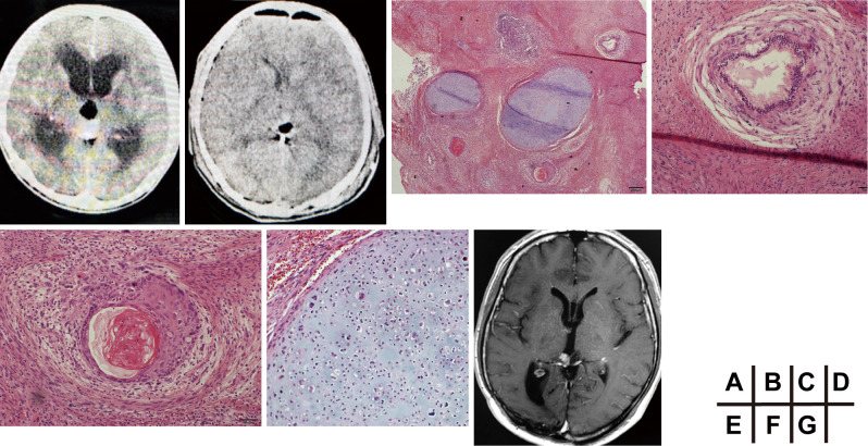 Pineal Region Tumor Resection — Figure 1