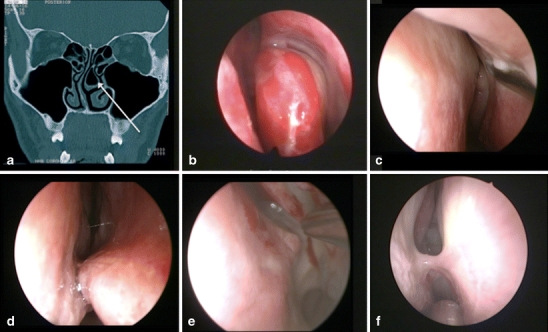 Pituitary Adenoma Endoscopic Endonasal Transsphenoidal Approach — Fig. 1