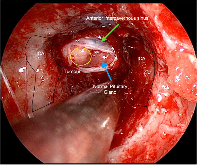 Pituitary Adenoma Endoscopic Endonasal Transsphenoidal Approach — Fig. 1