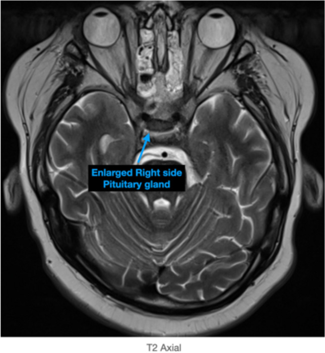 Pituitary Adenoma Endoscopic Endonasal Transsphenoidal Approach — Fig. 2