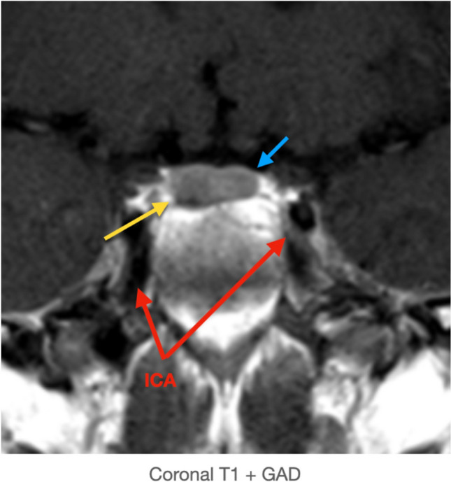 Pituitary Adenoma Endoscopic Endonasal Transsphenoidal Approach — Fig. 3