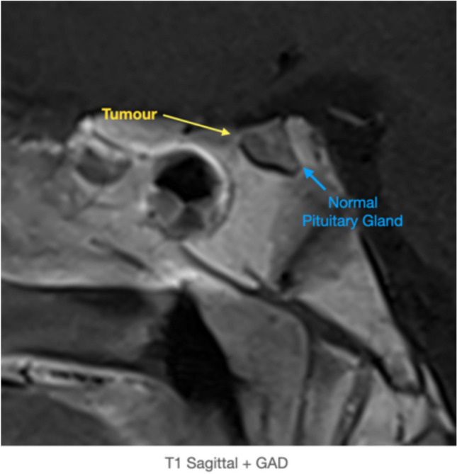 Pituitary Adenoma Endoscopic Endonasal Transsphenoidal Approach — Fig. 4
