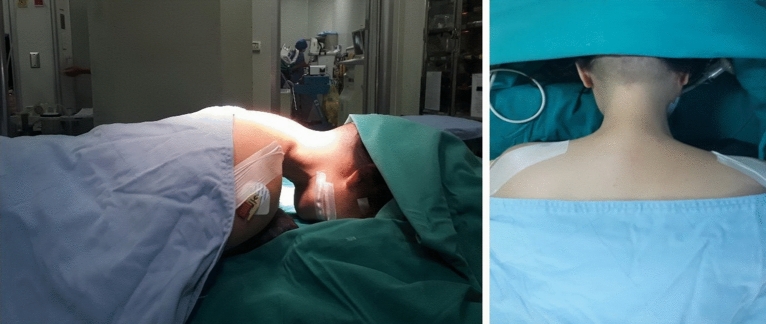 Posterior Cervical Foraminotomy — Figure 1