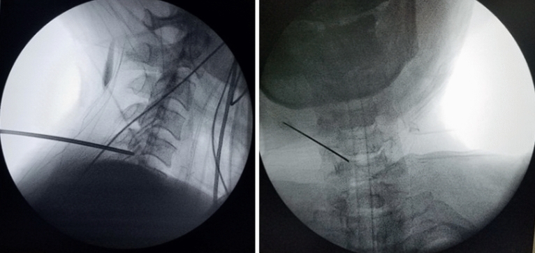Posterior Cervical Foraminotomy — Figure 2