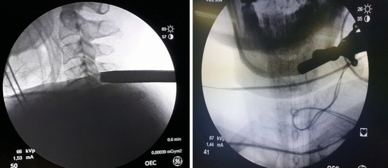 Posterior Cervical Foraminotomy — Figure 3