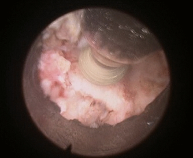 Posterior Cervical Foraminotomy — Figure 4