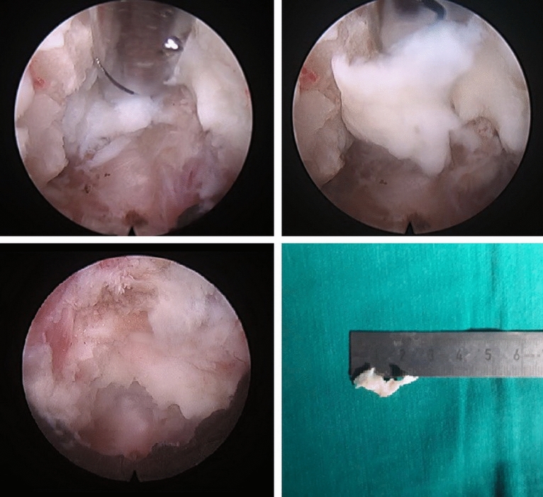 Posterior Cervical Foraminotomy — Figure 5
