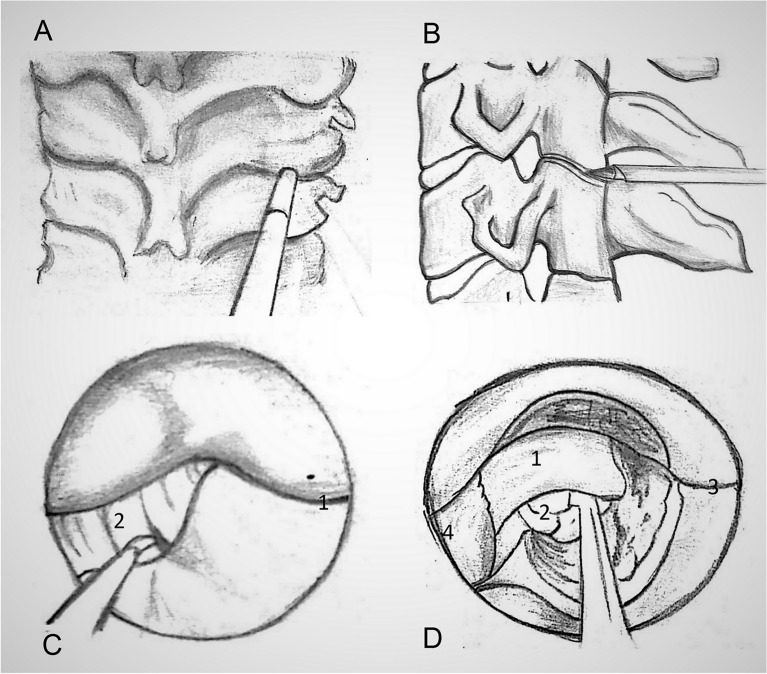 Posterior Cervical Foraminotomy — Figure 6