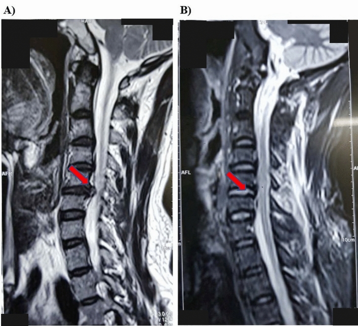 Posterior Cervical Foraminotomy — Figure 9