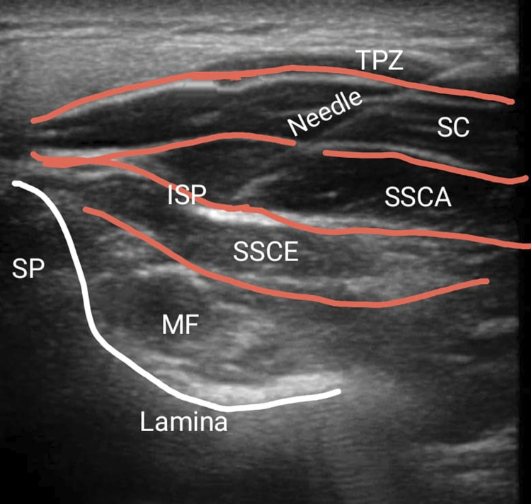 Posterior Cervical Laminectomy Fusion — Figure 2.