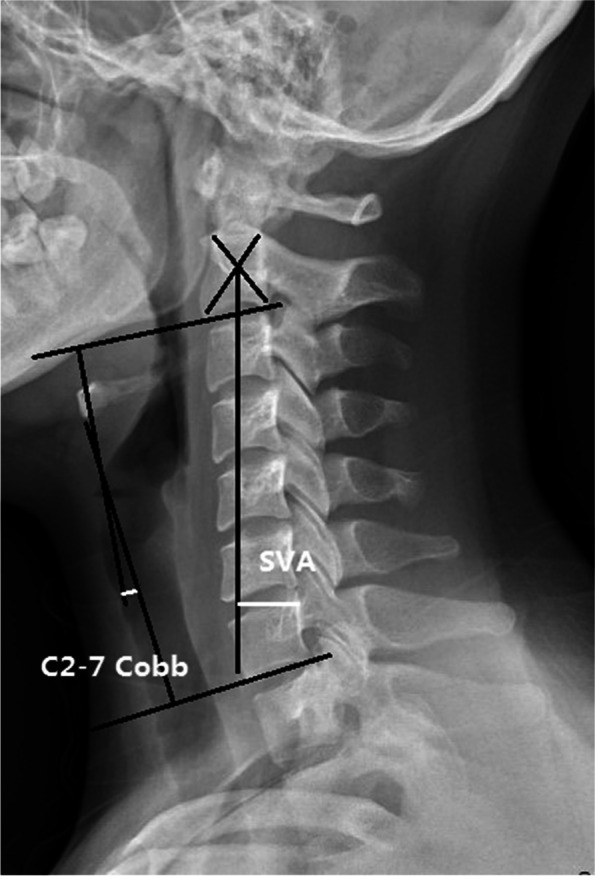 Posterior Cervical Laminectomy Fusion — Fig. 1