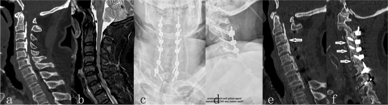 Posterior Cervical Laminectomy Fusion — Fig. 2