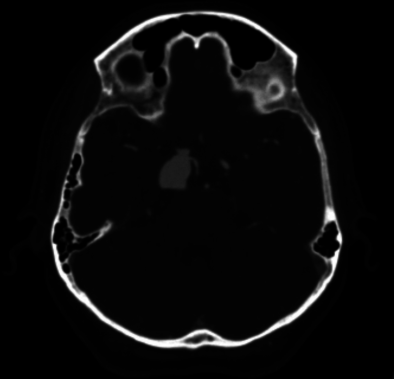 Posterior Communicating Artery Aneurysm Clipping — FIG. 1.