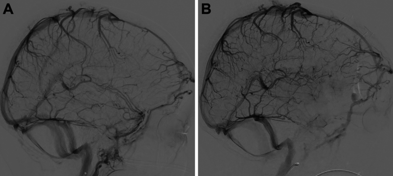 Posterior Communicating Artery Aneurysm Clipping — FIG. 2.