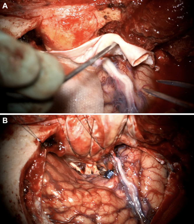 Posterior Communicating Artery Aneurysm Clipping — FIG. 3.