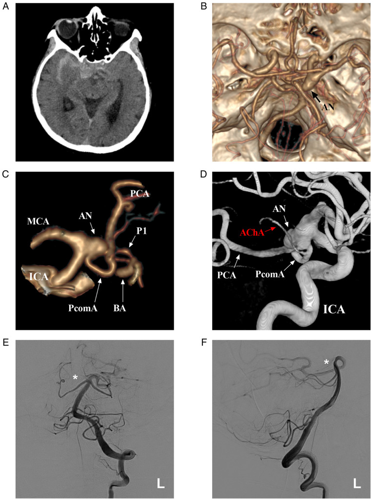 Posterior Communicating Artery Aneurysm Clipping — Figure 1
