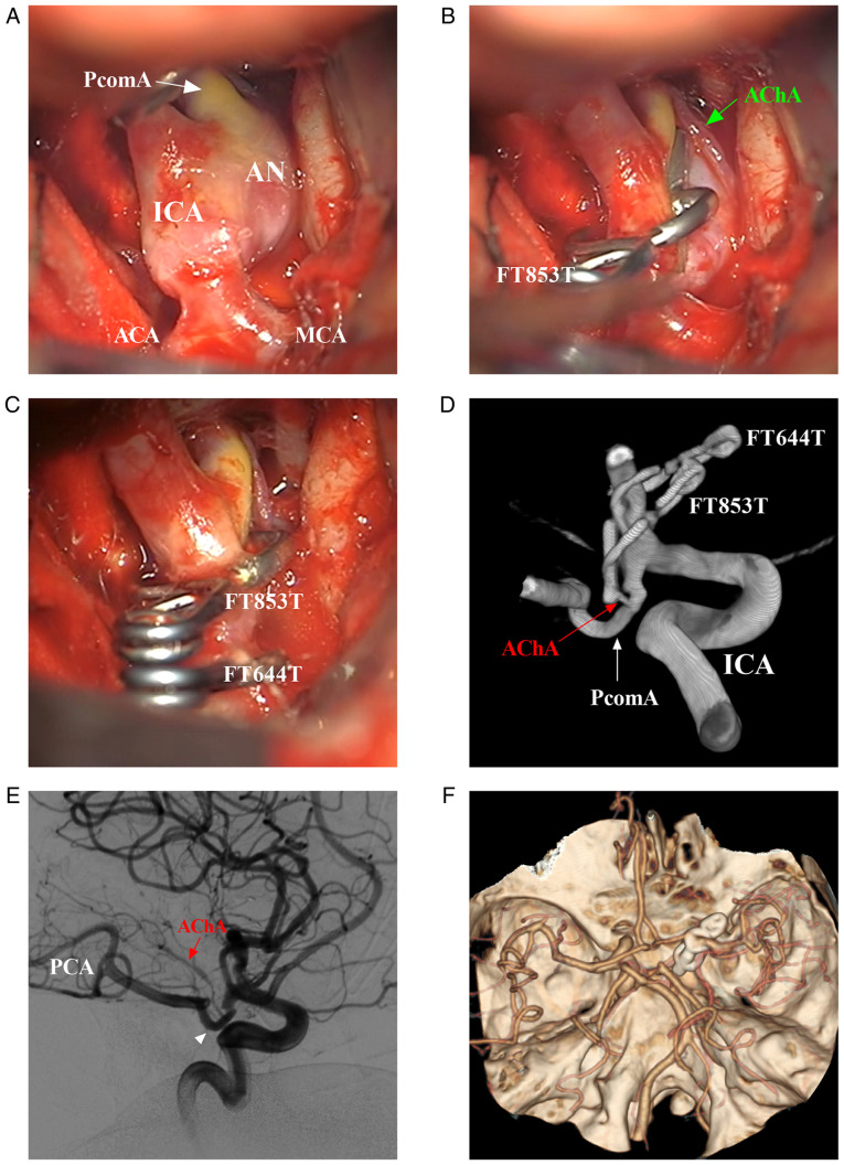 Posterior Communicating Artery Aneurysm Clipping — Figure 2