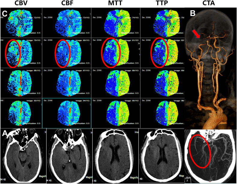 Posterior Communicating Artery Aneurysm Clipping — Fig. 1