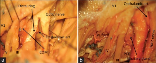 Posterior Communicating Artery Aneurysm Clipping — Figure 3