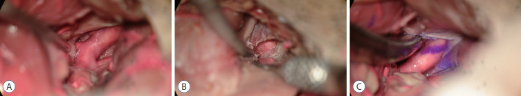Posterior Communicating Artery Aneurysm Clipping — Fig. 1.