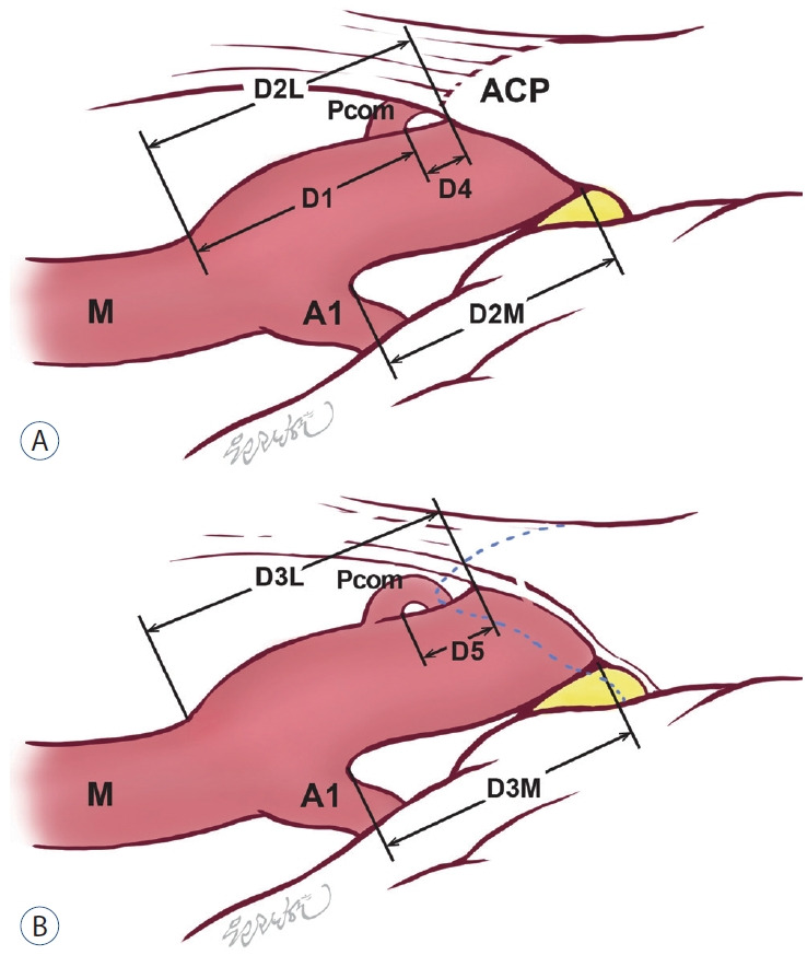 Posterior Communicating Artery Aneurysm Clipping — Fig. 2.