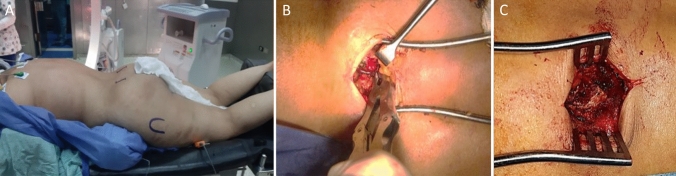 Sacral Fracture Spinopelvic Fixation — Fig. 1