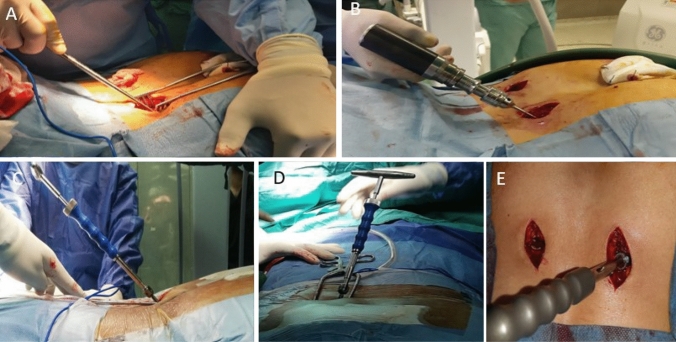 Sacral Fracture Spinopelvic Fixation — Fig. 2