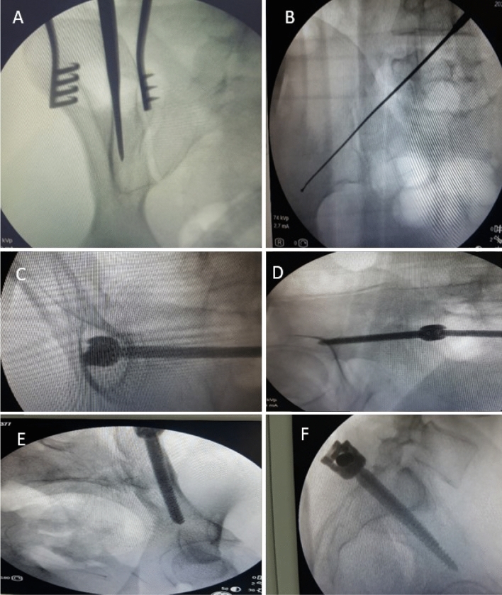 Sacral Fracture Spinopelvic Fixation — Fig. 3