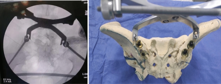 Sacral Fracture Spinopelvic Fixation — Fig. 4