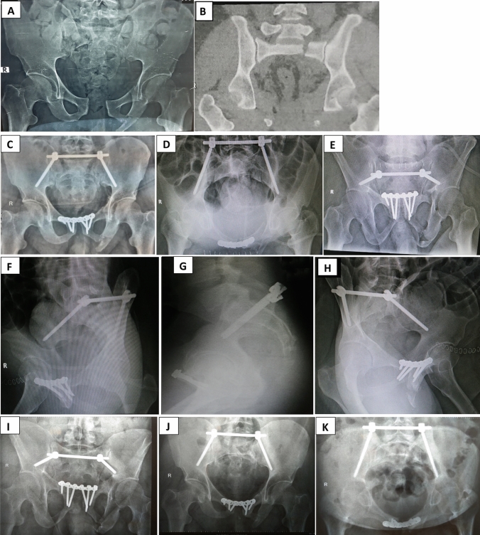 Sacral Fracture Spinopelvic Fixation — Fig. 5