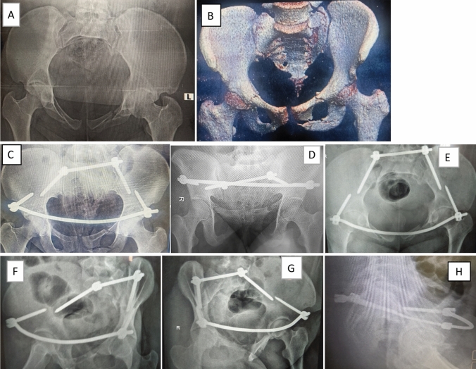 Sacral Fracture Spinopelvic Fixation — Fig. 6