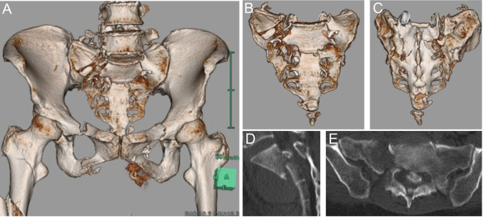 Sacral Fracture Spinopelvic Fixation — Fig. 1