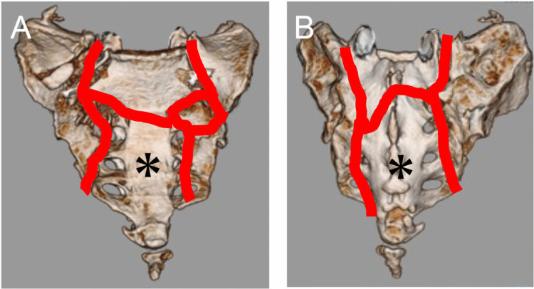 Sacral Fracture Spinopelvic Fixation — Fig. 2