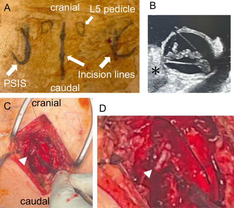 Sacral Fracture Spinopelvic Fixation — Fig. 3