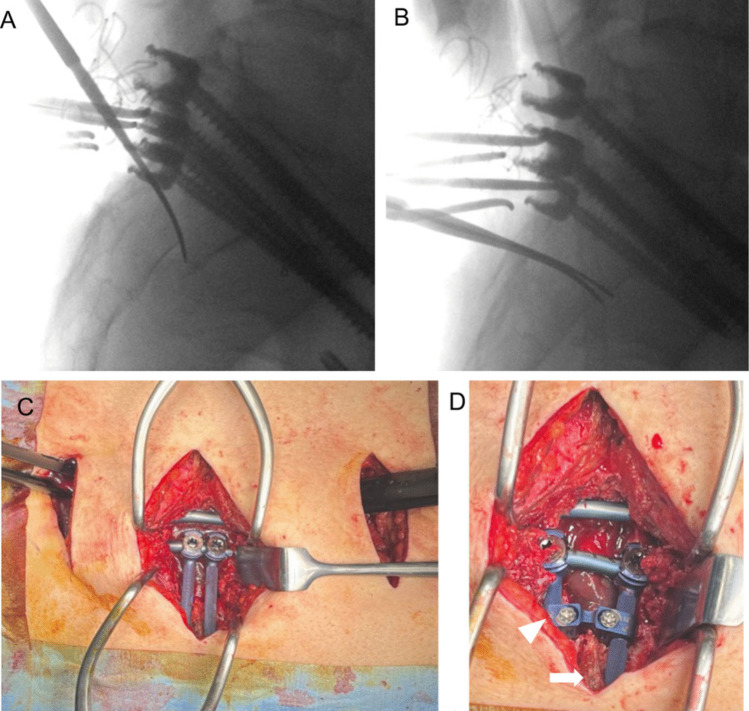 Sacral Fracture Spinopelvic Fixation — Fig. 4