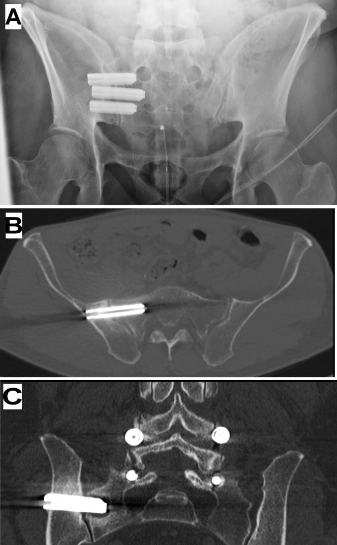 Sacroiliac Joint Fusion — Fig. 7