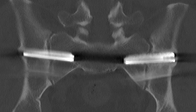 Sacroiliac Joint Fusion — Fig. 8