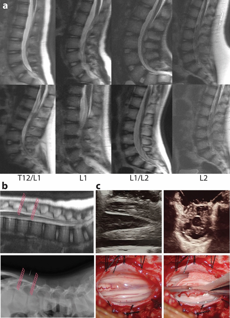 Selective Dorsal Rhizotomy — Fig. 1