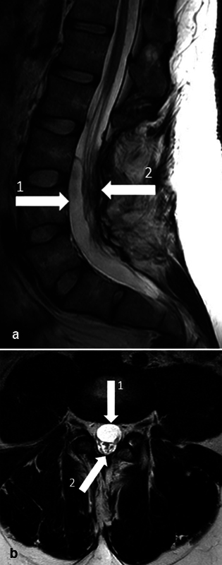 Selective Dorsal Rhizotomy — Fig. 1