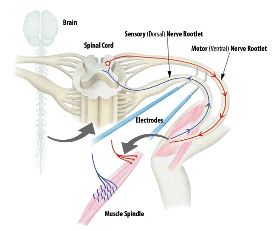 Selective Dorsal Rhizotomy — Fig. 2