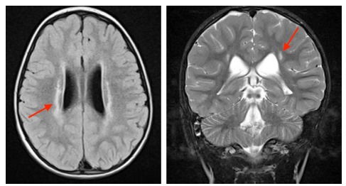 Selective Dorsal Rhizotomy — Fig. 7