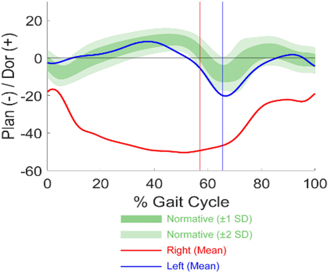 Selective Dorsal Rhizotomy — FIG. 1.