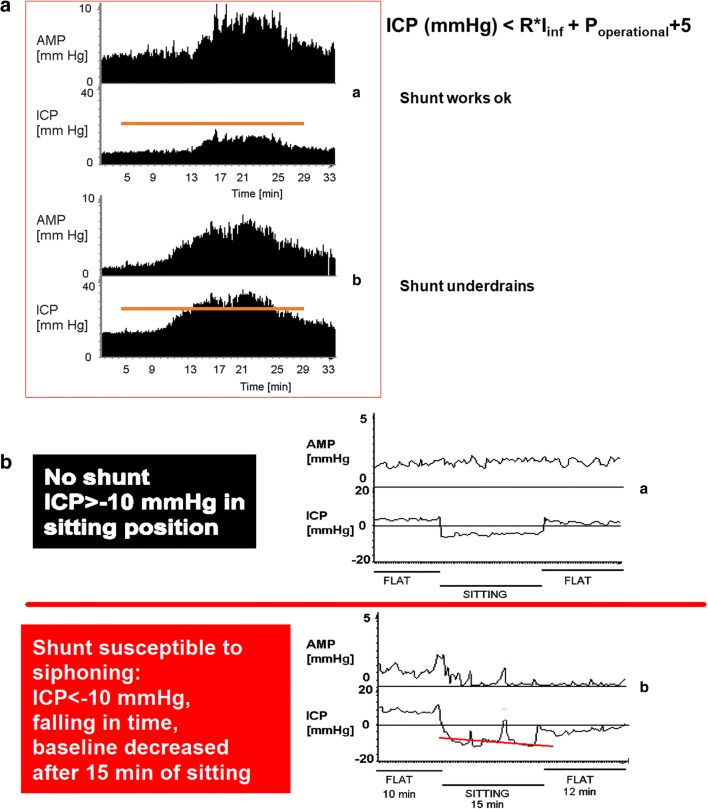 Shunt Revision Exploration — Fig. 1