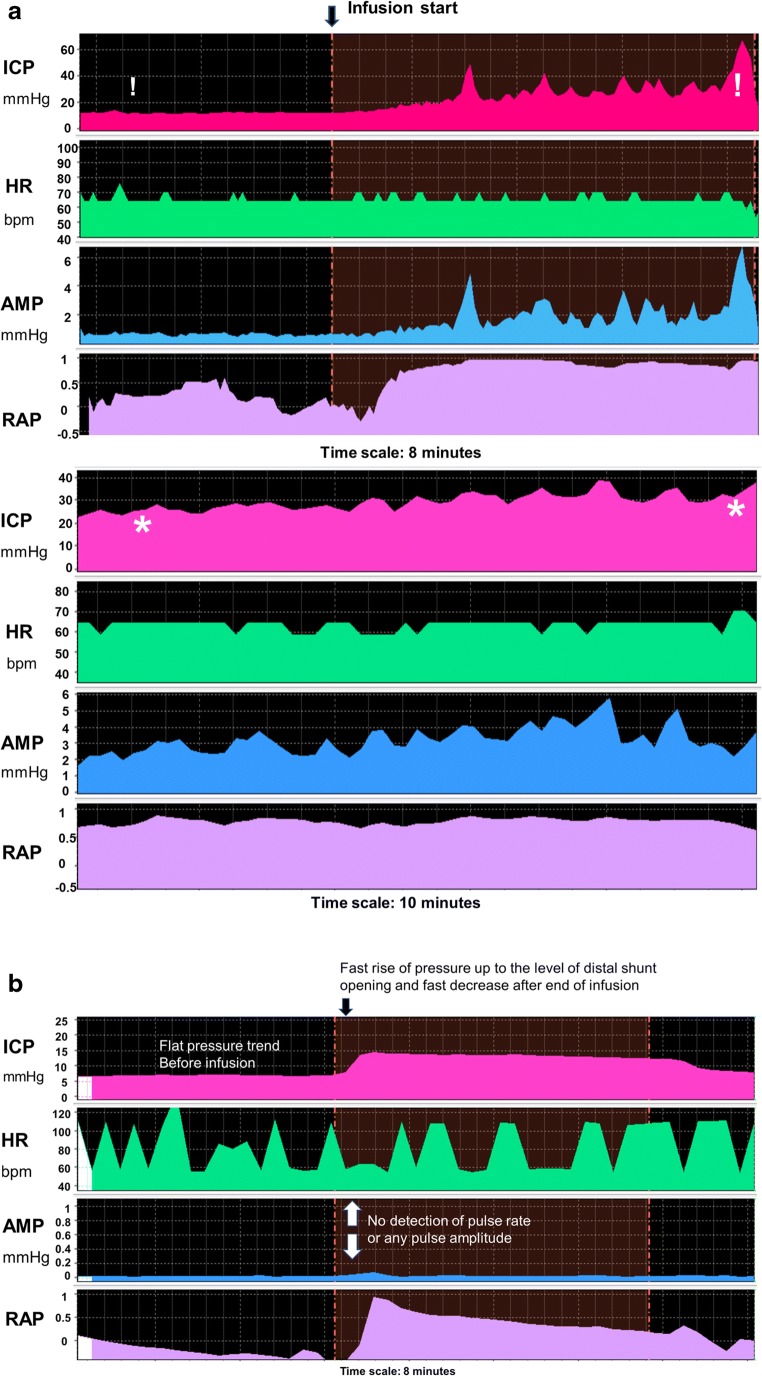 Shunt Revision Exploration — Fig. 2
