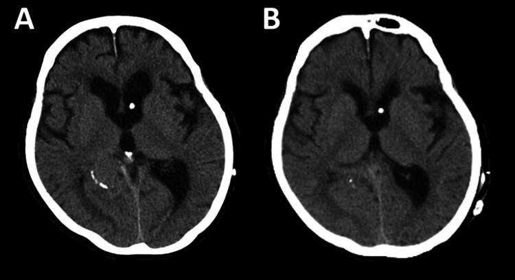 Shunt Revision Exploration — Figure 1