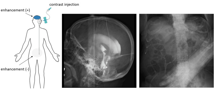 Shunt Revision Exploration — Figure 2