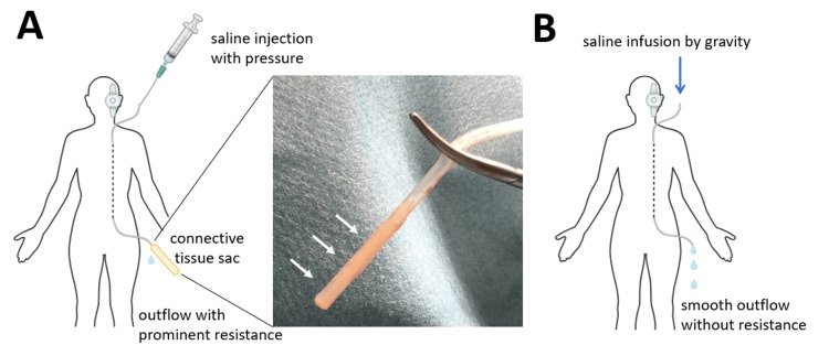 Shunt Revision Exploration — Figure 3