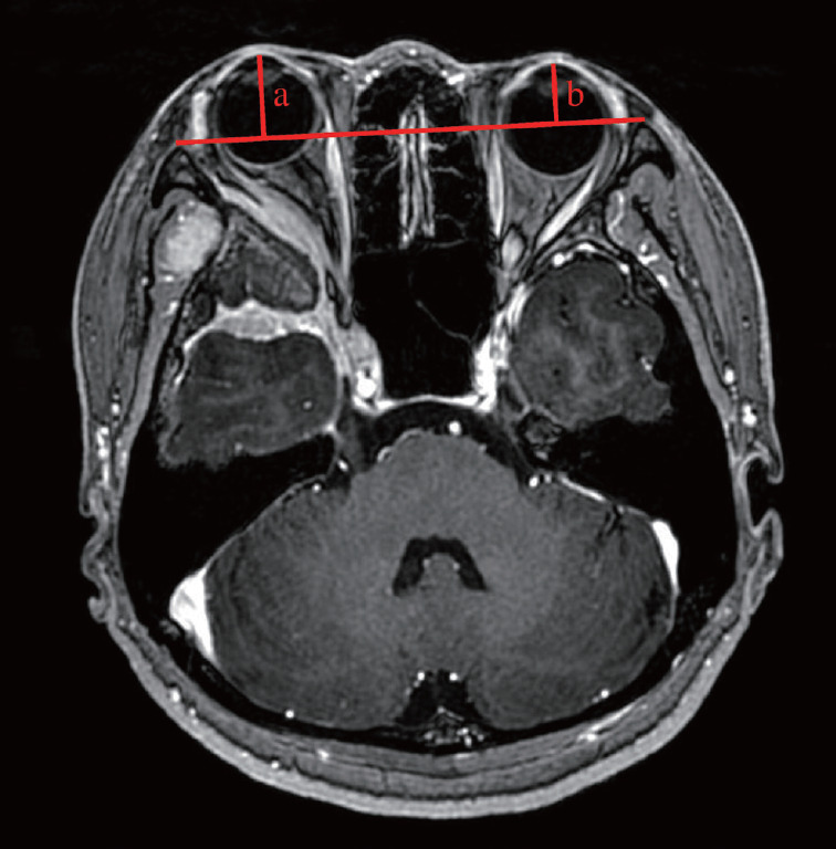 Sphenoid Wing Meningioma Resection — Fig. 1.