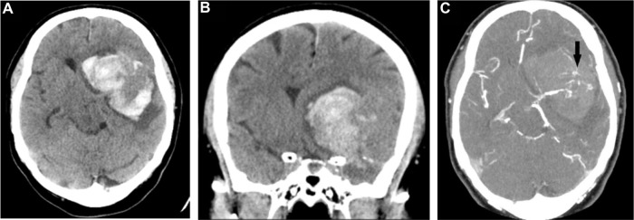 Sphenoid Wing Meningioma Resection — Figure 1