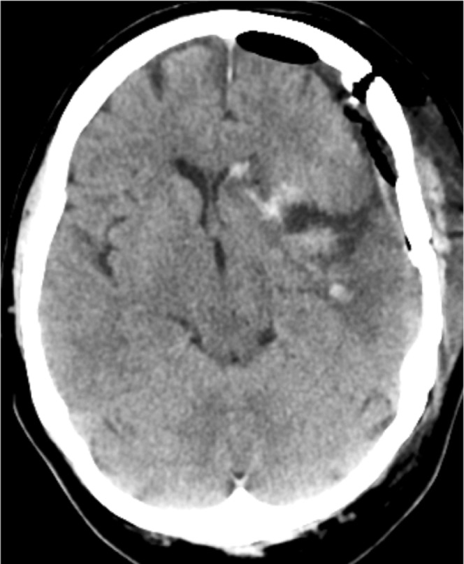 Sphenoid Wing Meningioma Resection — Figure 2